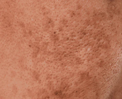 Pigmentation / Dark Spots
