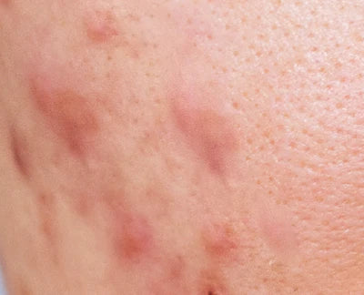 Acne Management